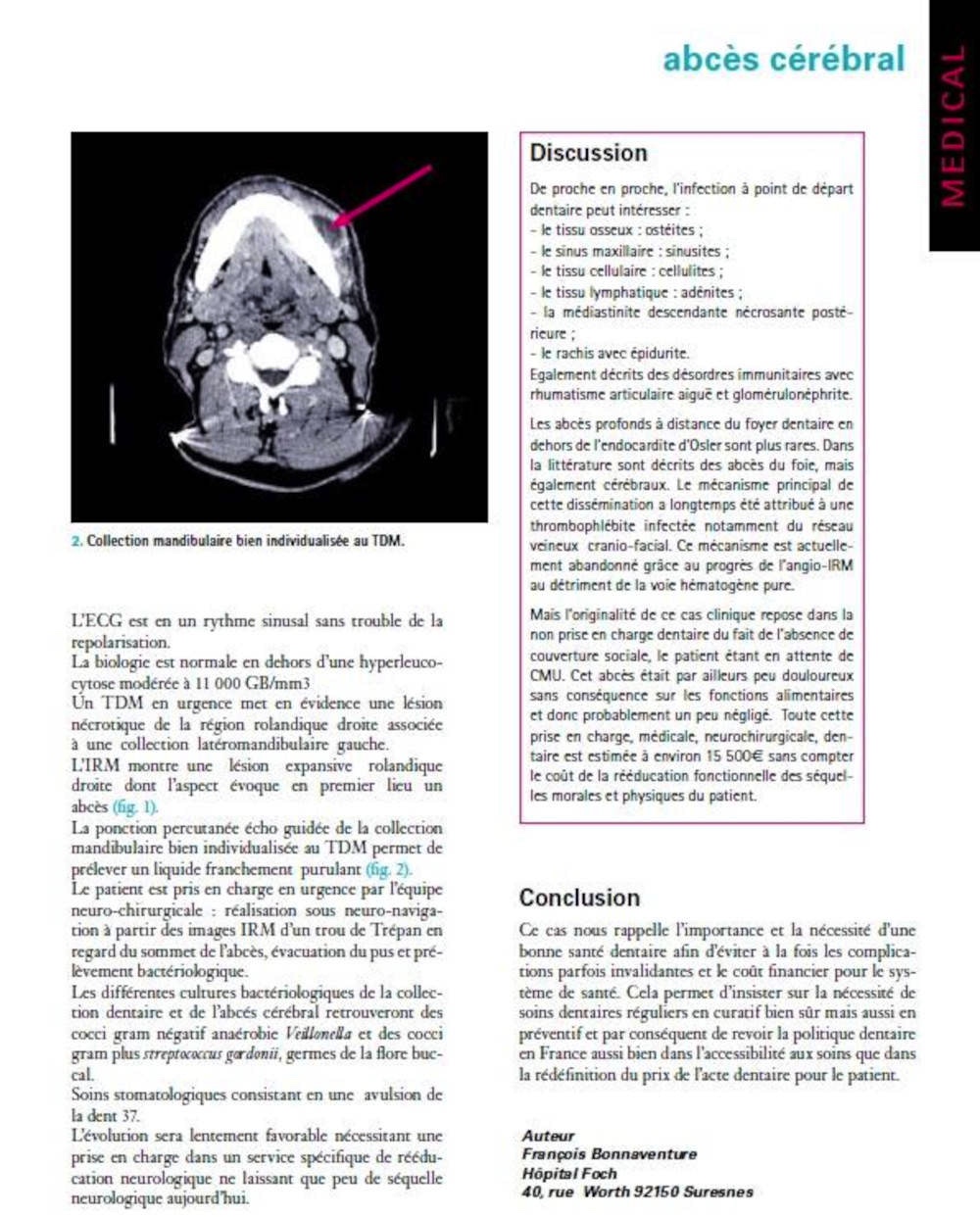 Informations patients abcès cérébral d’origine dentaire