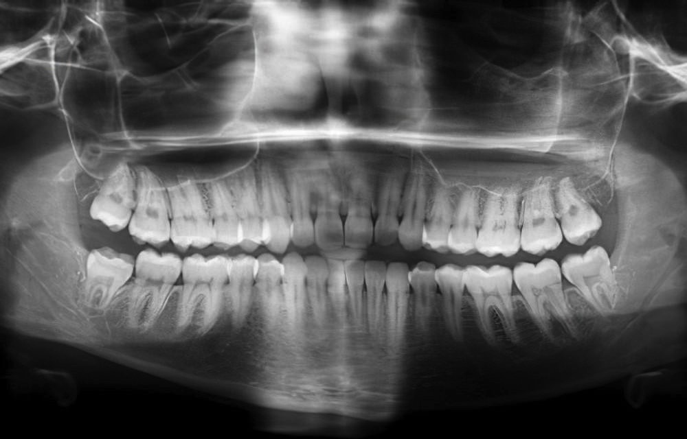 Informations patients dentiste Strasbourg radio panoramique