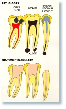 recommandations patients dentiste strasbourg traitement de racine dentaire